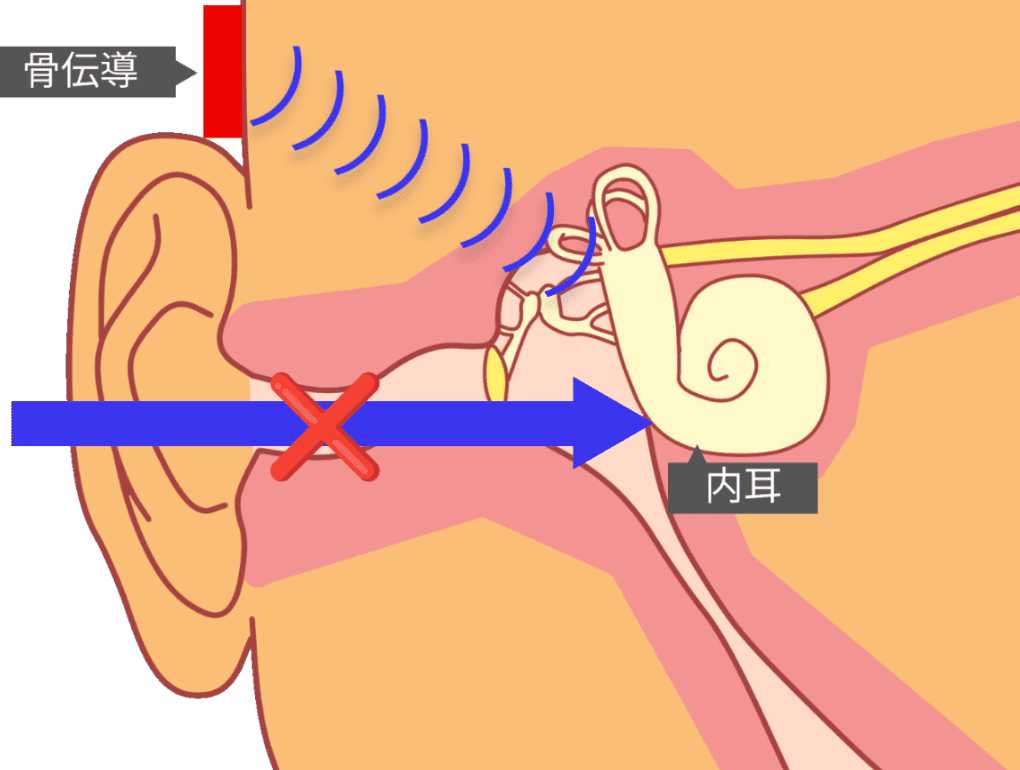 伝音難聴 骨伝導 効果